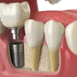 Implant zębowy w trakcie wszczepiania. Szukasz najtańszych implantów zębowych w Polsce? To rozwiązanie dla Ciebie.