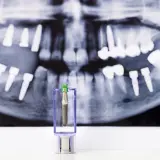 Zęby na zdjęciu RTG i implant w etui. Może to symbolizować odrzucenie implantu zęba lub jego przygotowanie.