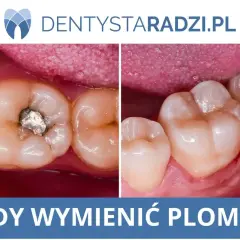 Porównanie zęba z amalgamatową plombą tymczasową i po jej wymianie na nową, estetyczną.