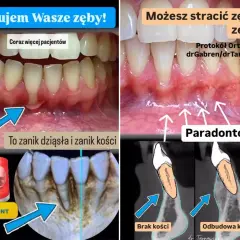 Przed i po leczeniu paradontozy: zanik dziąseł i kości, a następnie odbudowa. Ratujemy zęby!