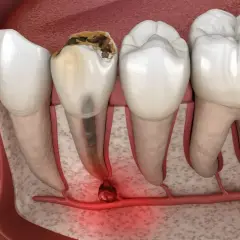 Zepsuty ząb z zapaleniem wierzchołka korzenia. To pokazuje, dlaczego endodoncja co to jest, jest ważna dla ratowania zębów.