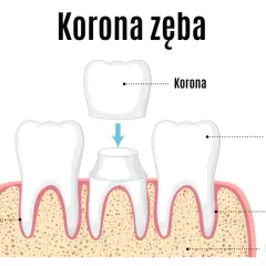 Ilustracja pokazuje proces zakładania korony na ząb. Zastanawiasz się, ile kosztuje koronka na jednego zęba?