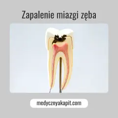 Model zęba ukazujący próchnicę i zapalenie miazgi. Widoczne są uszkodzone tkanki i czerwona miazga.