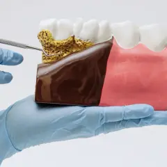Model szczęki z widocznym spuchniętym dziąsłem i kamieniem nazębnym, badany narzędziem dentystycznym.