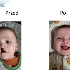 Uśmiechnięty chłopiec po korekcie zajęczej wargi. Po lewej widać szew, po prawej uśmiech.