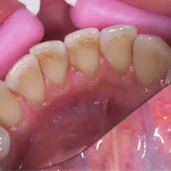 Widoczne przebarwienia i czarny osad na zębach, widoczne są też różowe retraktory dentystyczne.