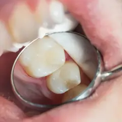 Dentysta bada zęby, szukając próchnicy ukrytej. Widoczne są zęby, lusterko dentystyczne i wata.