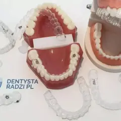 Nakładki czy aparat? Cena, komfort, skuteczność co wybrać?
