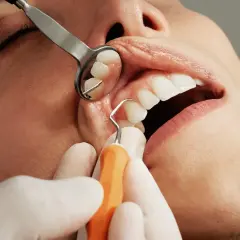 Dentysta usuwa kamień z zębów. Czy usuwanie kamienia boli? Zazwyczaj nie, ale zależy od wrażliwości pacjenta.
