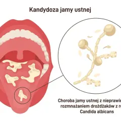 Ilustracja przedstawia jamę ustną z białymi nalotami na języku i podniebieniu, wskazującymi na grzybicę jamy ustnej. Obok powiększony obraz drożdżaków Candida albicans.