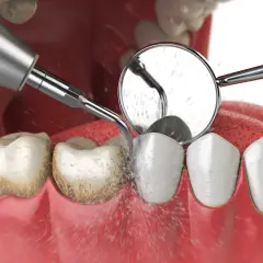 Zabieg odkamieniania zębów: ultradźwiękowe usuwanie kamienia nazębnego z widocznym strumieniem wody i odbiciem w lusterku dentystycznym.