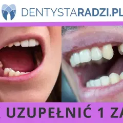Dwa zbliżenia ust pokazujące braki w uzębieniu. Po lewej stronie widać palec wskazujący na brakujący ząb. Po prawej stronie widoczny jest brakujący ząb. Temat: hipodoncja.