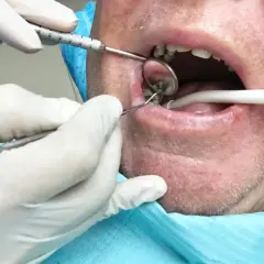 Dentysta w białych rękawiczkach wykonuje usuwanie korzenia zęba, używając lusterka i narzędzi.