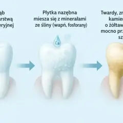 Proces powstawania kamienia nazębnego: od czystego zęba, przez płytkę mieszającą się z minerałami, aż do żółtawego kamienia z czarnymi kropkami.