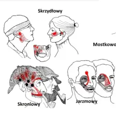 Ilustracje pokazują punkty bólu związane z różnymi typami bólu głowy, które mogą być mylone z objawami nowotworu stawu skroniowo-żuchwowego.