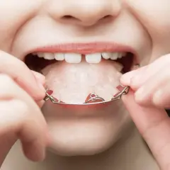 Aparat na zęby dla dziecka: Jak wygląda? Ruchomy, stały, Invisalign