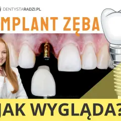 Implant zęba przed i po: widok na implant w dziąśle, protezę zębową i uśmiechniętą dentystkę.