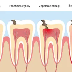 Ząb boli? Sprawdź, czy infekcja nie zagraża całemu organizmowi.