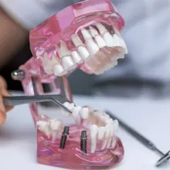 Model szczęki pokazuje wstawienie zęba. Pęseta trzyma protezę, która ma być umieszczona na implantach.