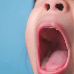 Dziecko krzyczy z bólu, bo ma poparzone podniebienie.