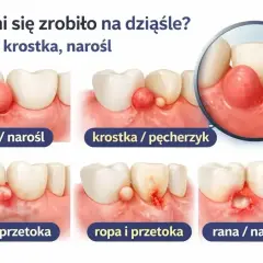Ilustracja pokazuje różne zmiany na dziąśle: guzek, krostkę, ropień i ranę. Torbiel na dziąśle może przybierać różne formy.