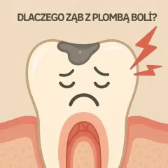 Smutny ząb z plombą i czerwonymi błyskawicami symbolizującymi ból zęba po plombowaniu.