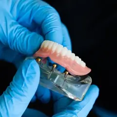 Ręce w niebieskich rękawiczkach trzymają model szczęki z implantami i cienkie protezy zębowe.