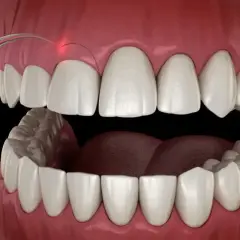 Zabieg gingiwektomii laserem. Precyzyjne modelowanie dziąseł dla pięknego uśmiechu.