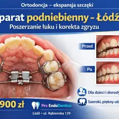 Aparat podniebienny w trakcie leczenia ortodontycznego. Zdjęcia "przed" i "po" pokazują korektę zgryzu.