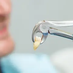 Chwila po wyrwaniu zęba, gdy dentysta trzyma go w kleszczach. Pacjent w tle uśmiecha się z ulgą.