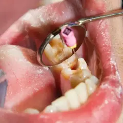 Zgorzel zęba w odbiciu lusterka dentystycznego. Widoczny jest ząb z ubytkiem i narzędzie stomatologiczne.