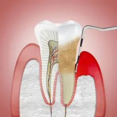 Przekrój zęba z widocznymi naczyniami krwionośnymi i nerwami. Narzędzie dentystyczne usuwa kamień nazębny, odsłaniając zdrowe przyzębie.