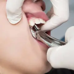 Dentysta wyrywa ząb kleszczami. Czy wyrywanie zęba boli? To zależy od znieczulenia i indywidualnego progu bólu.