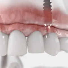 Model szczęki z implantami. Widoczne podniesienie dna zatoki szczękowej, przygotowanie do wszczepienia implantów.