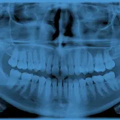 Pantomogram zębów, który pokazuje pełny obraz szczęki i żuchwy. Zastanawiasz się, ile kosztuje pantomogram?