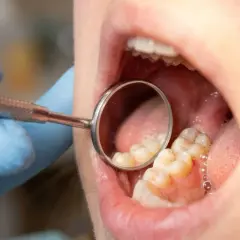 Dentysta w niebieskiej rękawiczce bada zęby lusterkiem. Widać na nich osad, który może być początkiem płytki nazębnej.