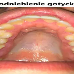 Widok jamy ustnej z zębami i podniebieniem. Charakterystyczne, wysokie podniebienie gotyckie, z widocznymi zębami trzonowymi i przedtrzonowymi.