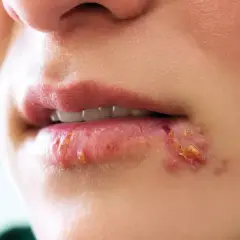 Usta z widoczną opryszczką. Czy z opryszczką można iść do dentysty? Warto skonsultować się z lekarzem.