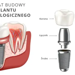 Schemat budowy implantu stomatologicznego. Dowiedz się, ile kosztuje zrobienie zębów i jakie są jego elementy: śruba, łącznik i korona.