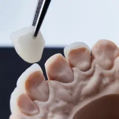 Precyzyjne dopasowanie korony porcelanowej na metalu do modelu szczęki.