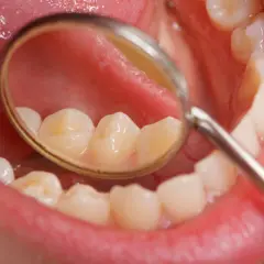 Widok jamy ustnej z lusterkiem dentystycznym, uwidaczniającym białe plamy na zębach.