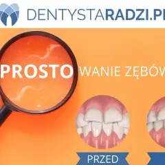Przed i po: proste zęby dzięki licówkom. Zobacz, jak licówki na krzywe zęby zmieniają uśmiech.