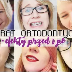 Aparat ortodontyczny a usta: Iluzja czy realna zmiana?