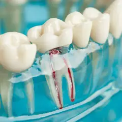Model zęba pokazuje leczenie kanałowe zęba krok po kroku. Widoczne są korzenie zęba z wypełnionymi kanałami.