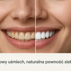 Bezpieczne wybielanie zębów: Jak często, by nie zniszczyć szkliwa?