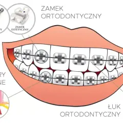 Jak działa aparat na zęby? Odkryj sekrety prostego uśmiechu!