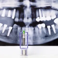 Zęby na zdjęciu RTG i implant w etui. Może to symbolizować odrzucenie implantu zęba lub jego przygotowanie.