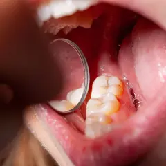Widok jamy ustnej z widocznymi zębami i lustrem dentystycznym. Na zębach widoczne są oznaki demineralizacji szkliwa, co może prowadzić do próchnicy.