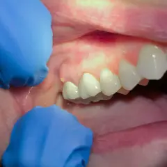 Widoczne ropa w zębie, zaczerwienione dziąsło i zęby. Rękawiczki dentystyczne uwidaczniają problem.