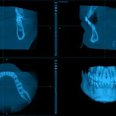 Trzy widoki badania CBCT szczęki i żuchwy, w tym widok 3D.